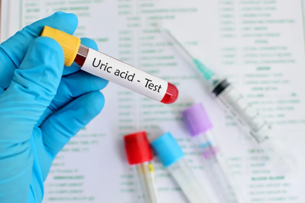 Uric acid test. 