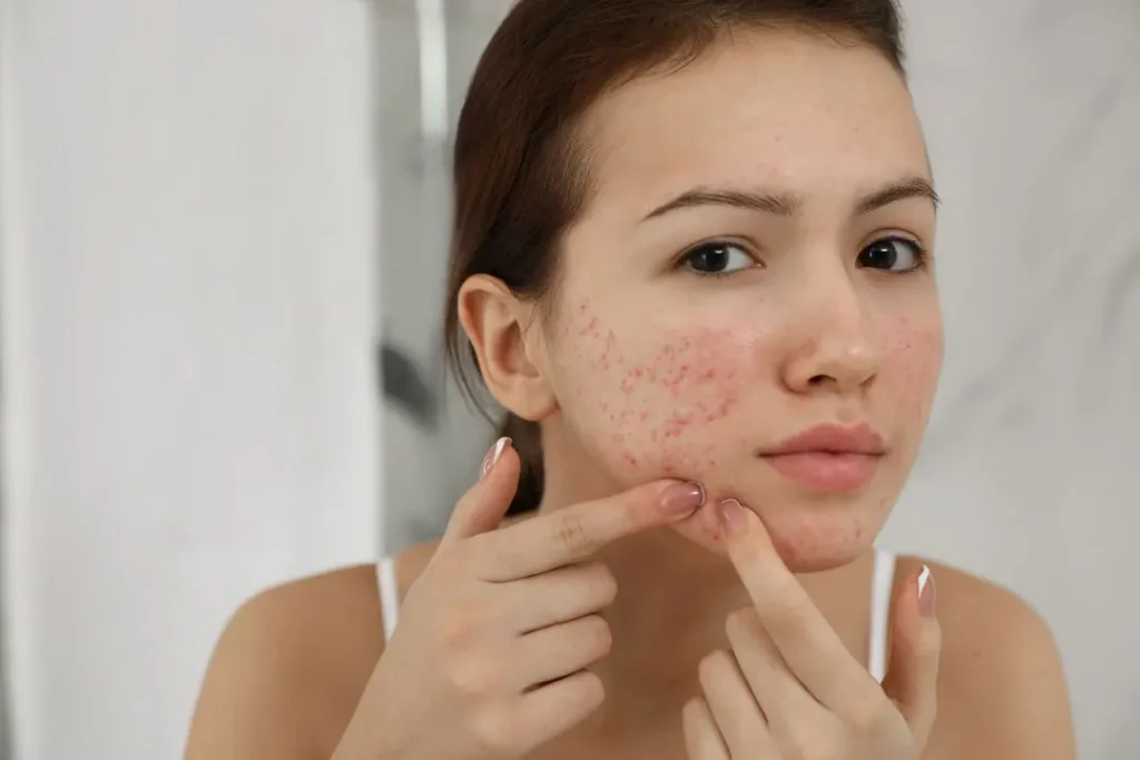 A young girl having acne. 