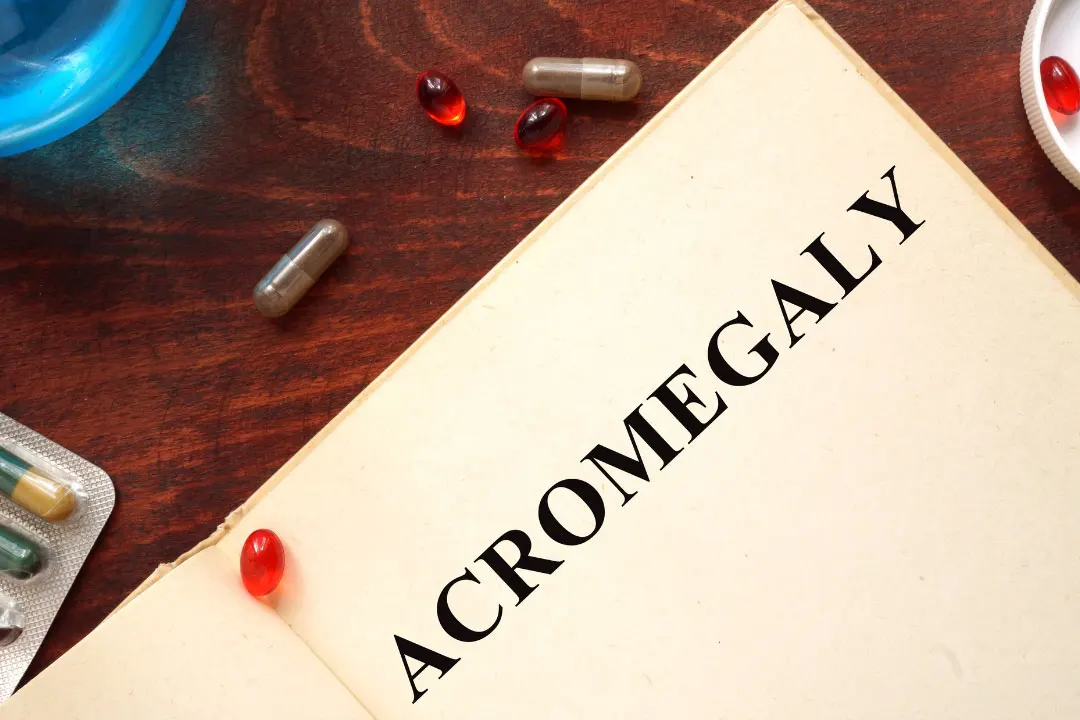 Acromegaly.