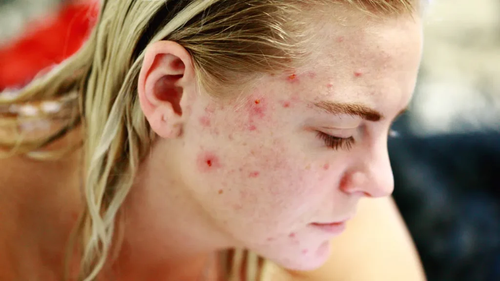 Acne issue. 