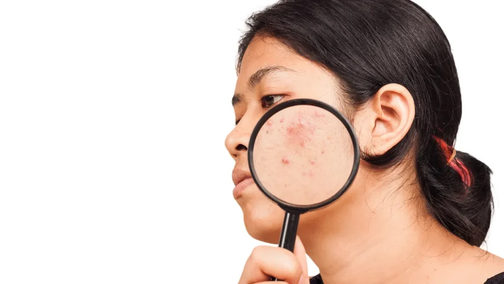Girl having active acne. 