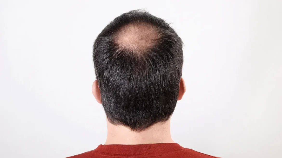 Alopecia Areata.