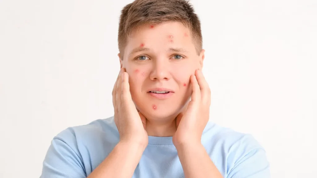 Young man facing Severe acne. 